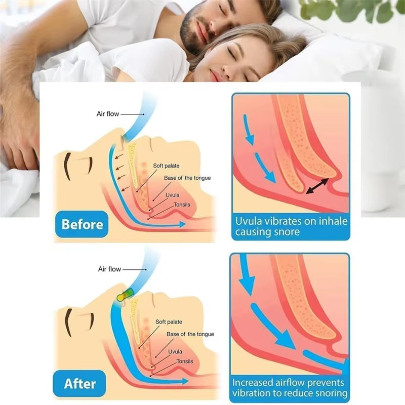 Anti Snoring Device to Stop Snoring Nose Clip for Easy Breathing Improvement Sleep Assistance Apnea 1Pc 2Pc 4Pc 6Pc 8Pc at Night
